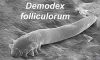 Demodex Mites: Link to Chronic Dry Eye Explained