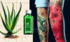 Burn Treatment Essentials for Effective Care: Key Steps