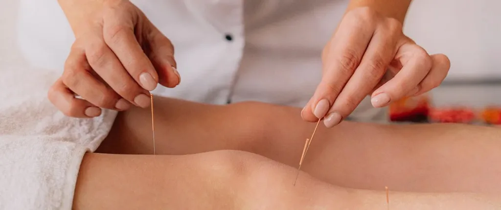 Acupuncture for Stress Relief: Your Essential Guide