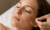 Cosmetic Acupuncture: Important Disadvantages to Know