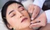 Cosmetic Acupuncture: Important Drawbacks You Should Know